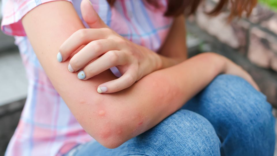 A pregnant woman examining her hand with a spider bite, looking concerned.