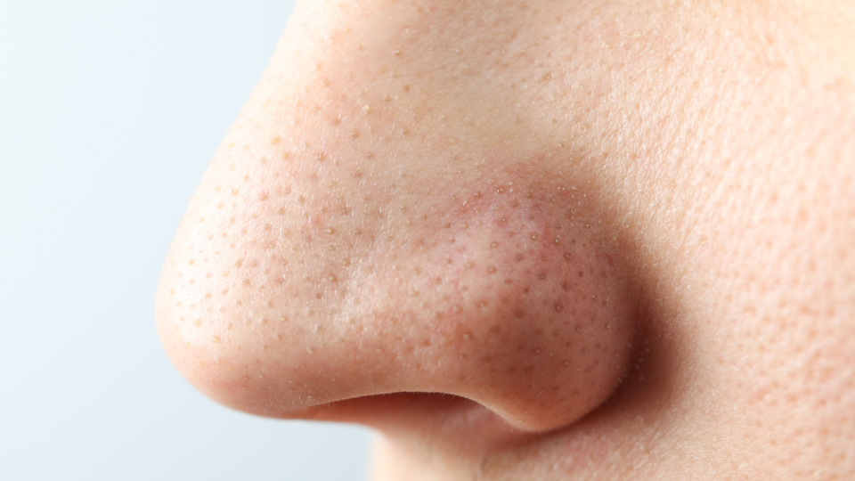 A pregnant woman applying a cold compress to her face to relieve nasal swelling.